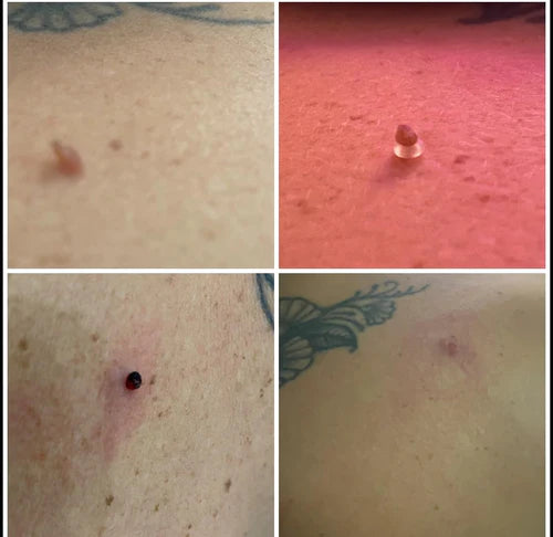 TagGone™ - Permanantly Remove Skin Tags At Home