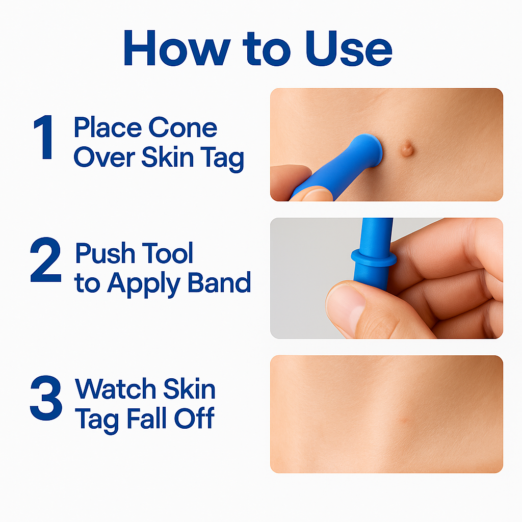 TagGone™ - Permanantly Remove Skin Tags At Home