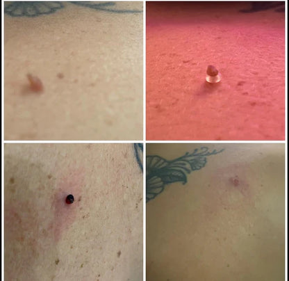 TagGone™ - Permanantly Remove Skin Tags At Home