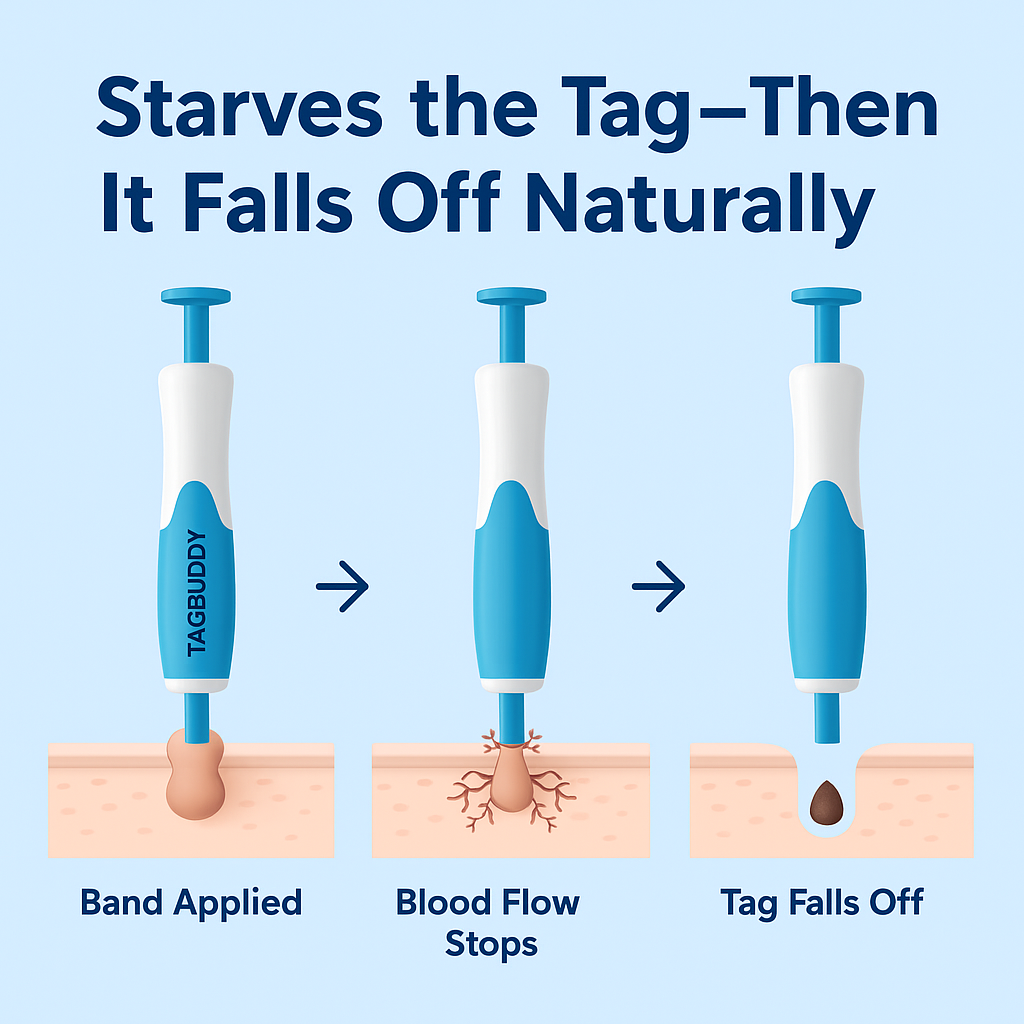 TagGone™ - Permanantly Remove Skin Tags At Home