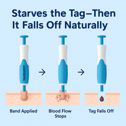 TagGone™ - Permanantly Remove Skin Tags At Home